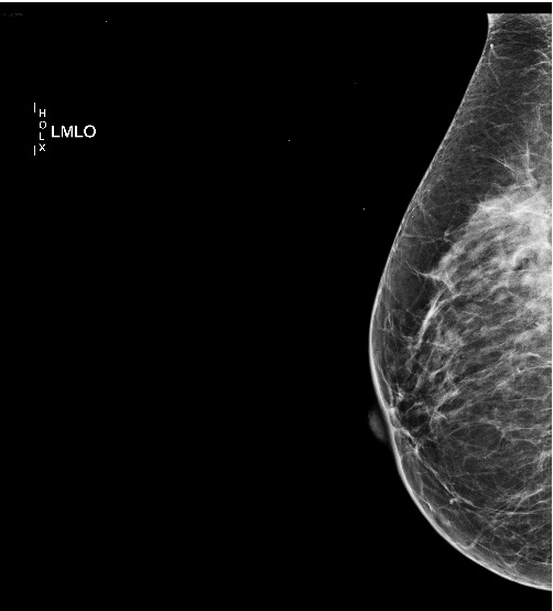 Диффузный фиброаденоматоз молочных желез что это такое. Кистозная мастопатия маммография. Фиброзно-кистозная мастопатия маммография. Диффузная мастопатия молочной железы маммография. Фиброзная мастопатия маммограмма.